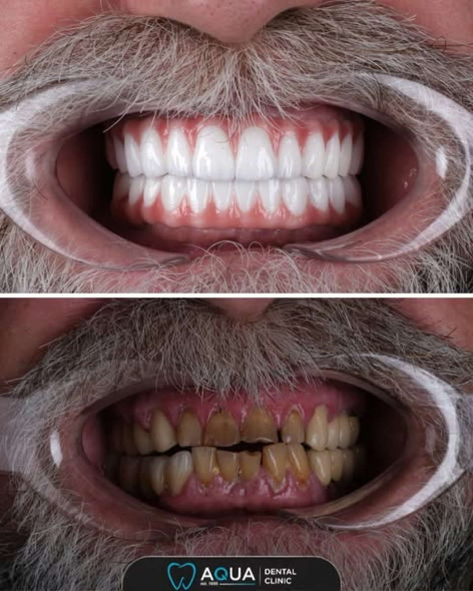 Resultados de blanqueamiento dental antes y después en Aqua Dental Clinic, sonrisa más blanca