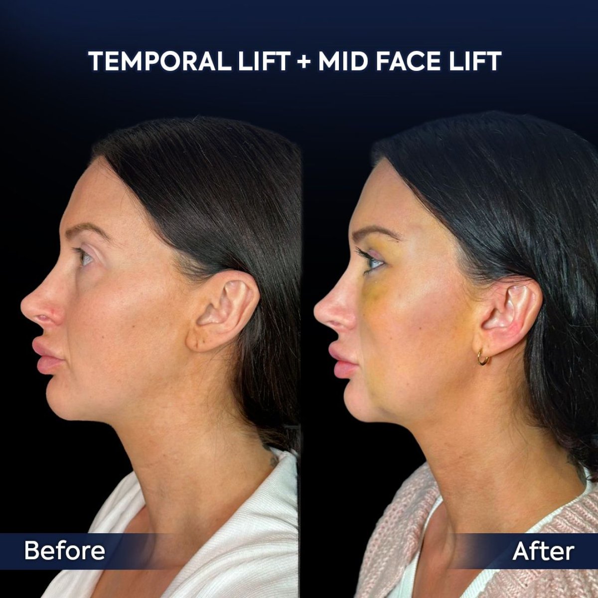Resultados antes y después de lifting temporal y de tercio medio en Dr. Safa Manav Clinic