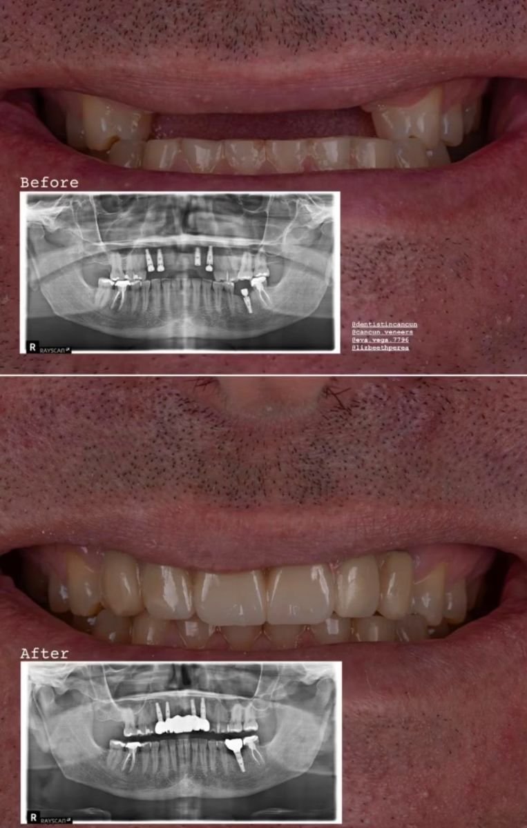Résultat avant/après implants All-on-4 à la clinique dentaire Shtern, sourire amélioré