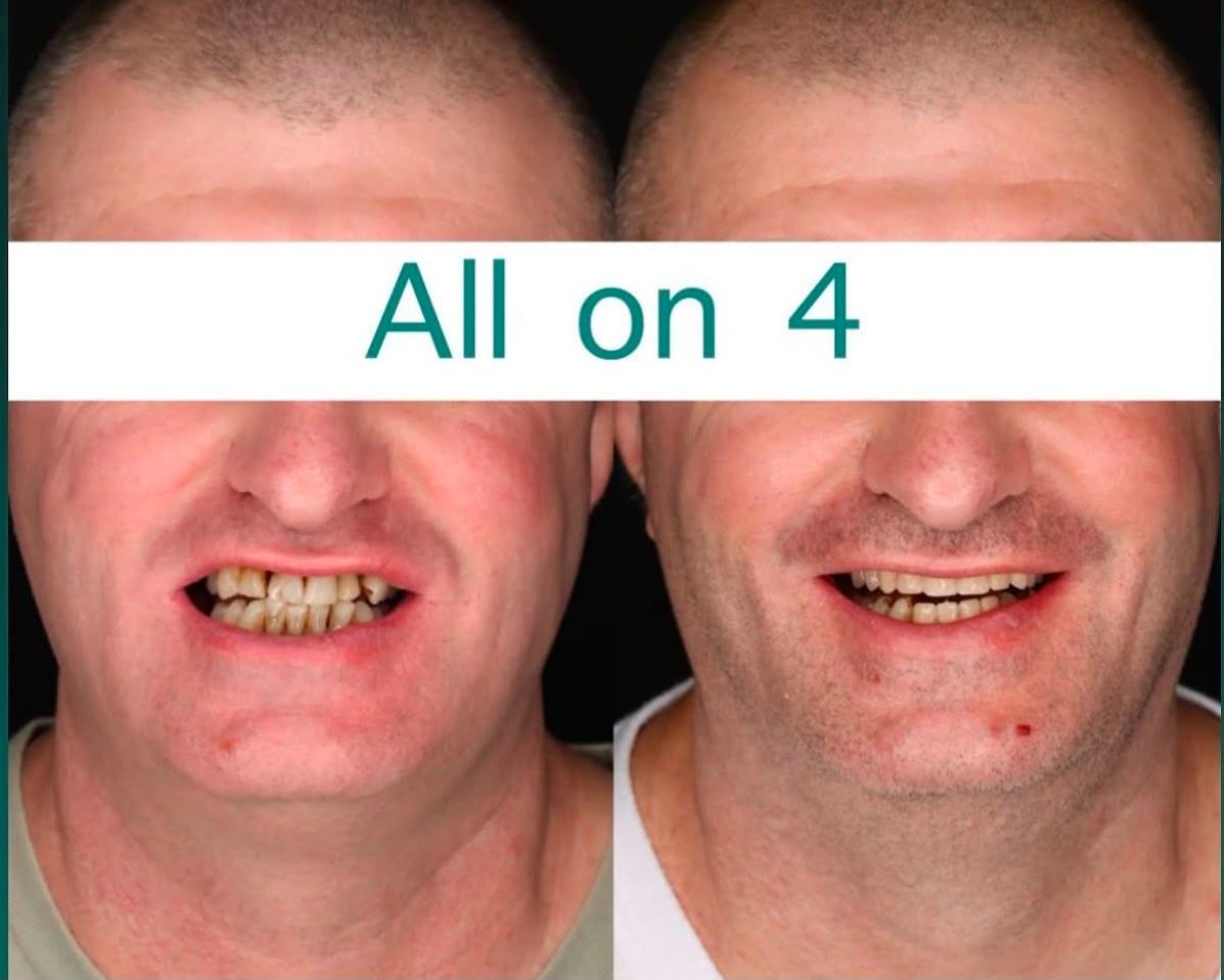 Before and after All-on-4 dental implants result at Shtern Dental Clinic, improved smile