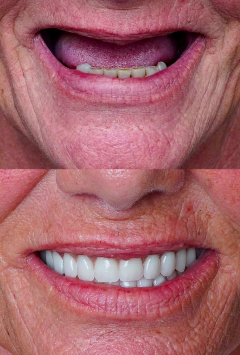 Before and after All-on-4 dental implants result at Shtern Dental Clinic, restored smile