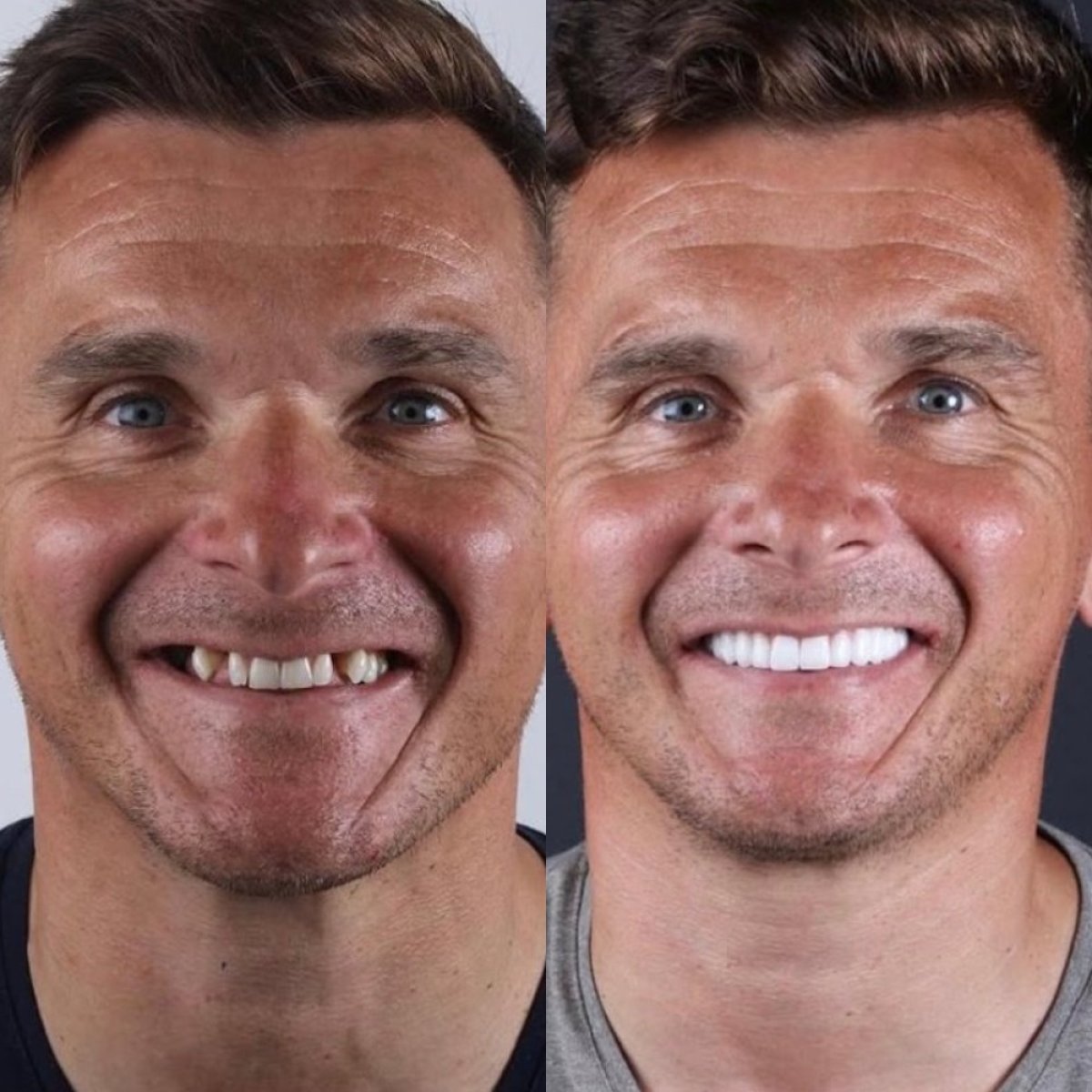 Hollywood Smile before and after results – full smile makeover with dental veneers