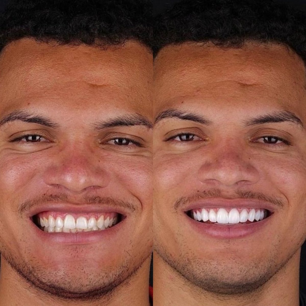 Результаты до и после Hollywood Smile – белые ровные зубы после установки виниров