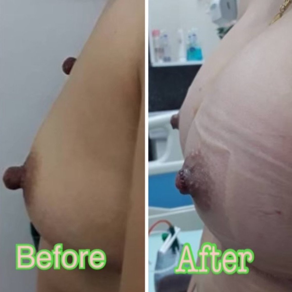 نتائج تصغير الحلمة قبل وبعد في ID Clinic Bangkok، مظهر محسّن للحلمة