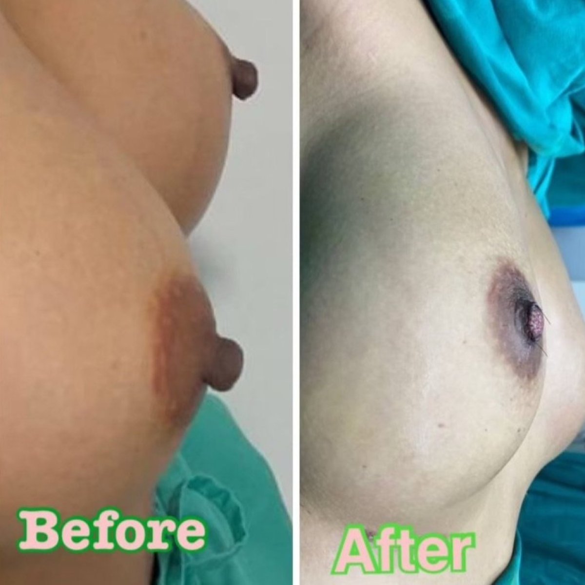 نتائج تصغير الحلمة قبل وبعد في ID Clinic Bangkok، مظهر حلمة محسّن