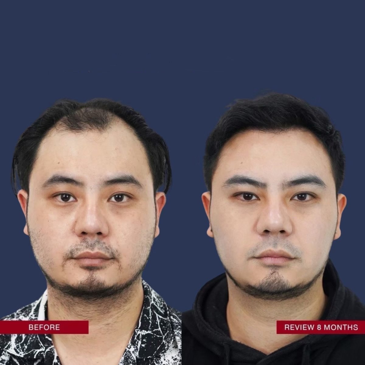 نتيجة زراعة الشعر قبل وبعد في ID Clinic Bangkok، خط شعر أكثر كثافة بعد 8 أشهر