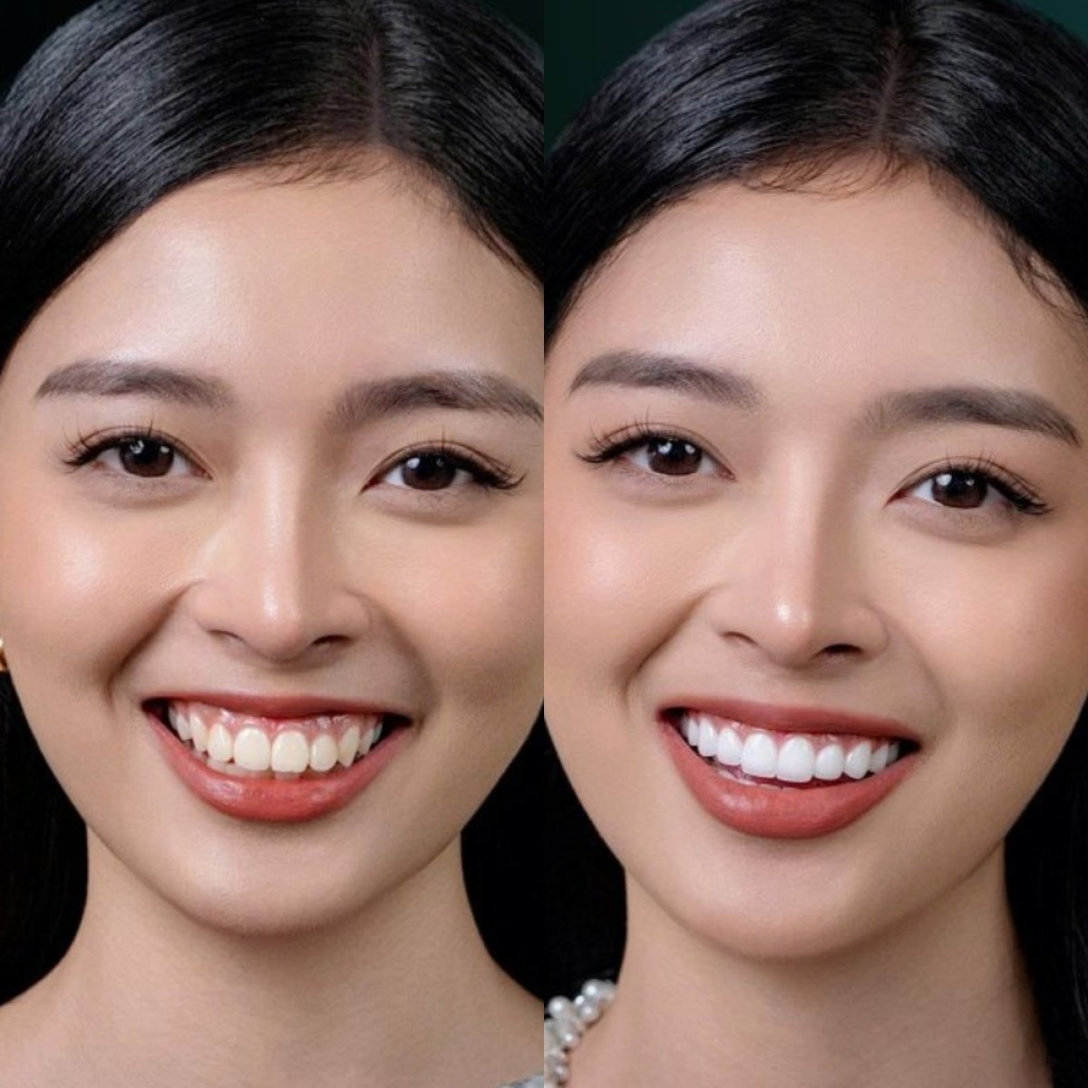 Before and after dental crown installation results – improved smile aesthetics and alignment