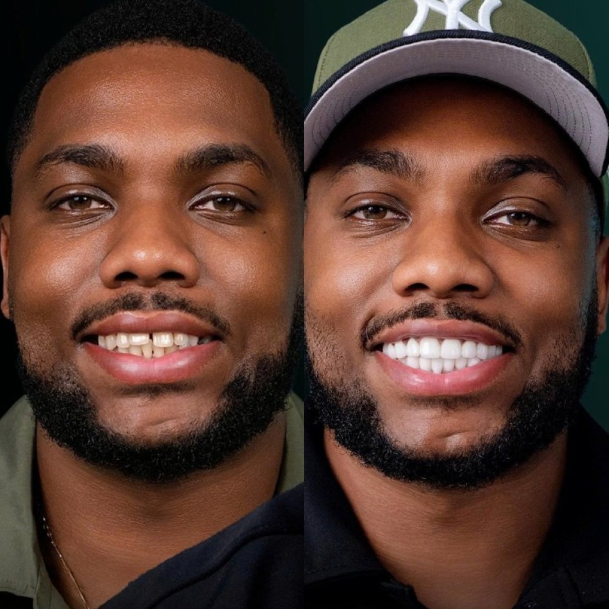 Before and after dental crown installation results – improved smile and aligned teeth