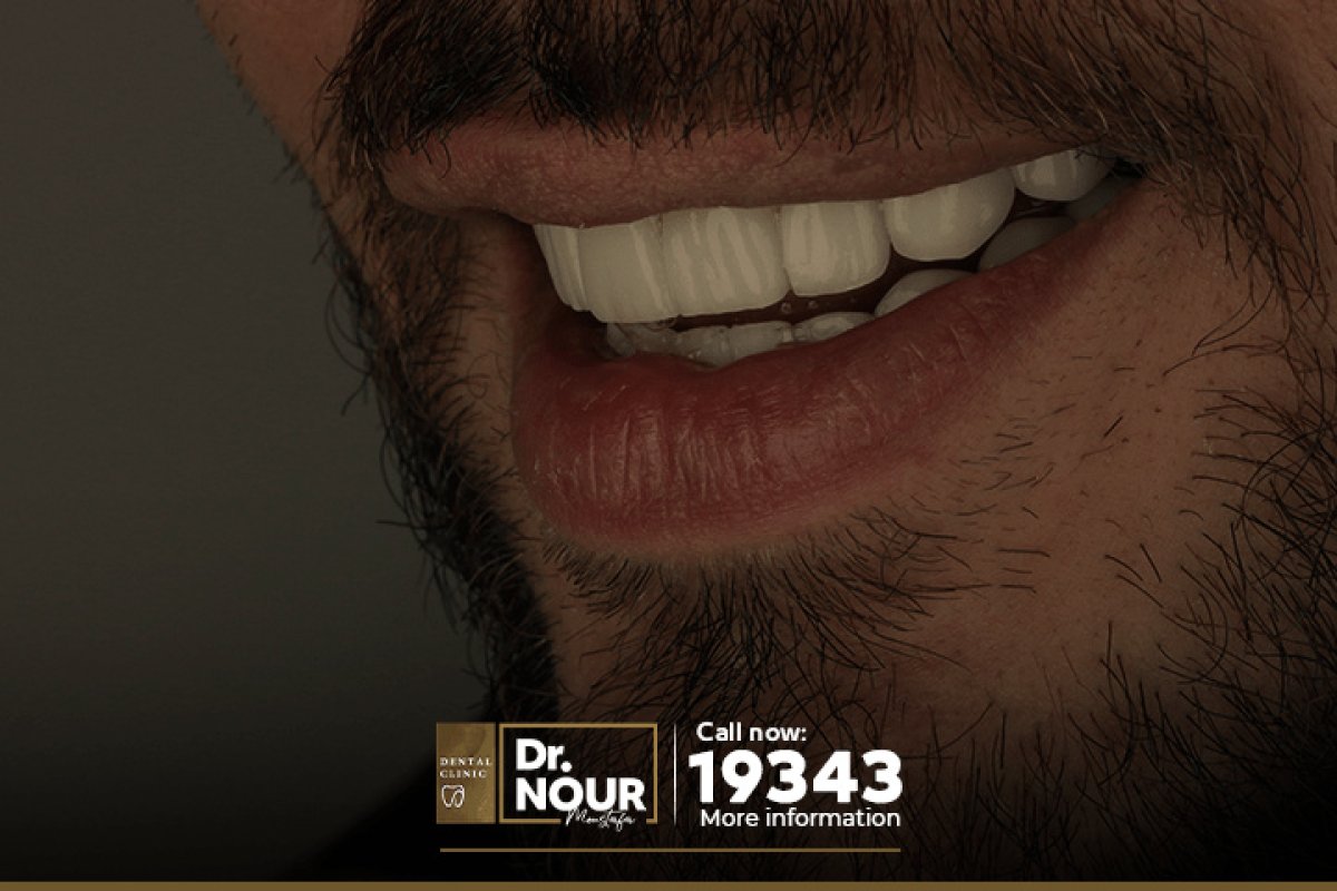 Résultat des facettes en zircon chez Dr. Nour Dental Clinic – sourire masculin amélioré