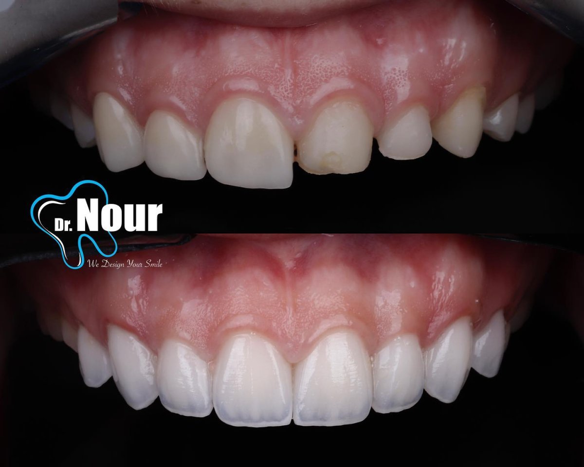 Résultat avant/après facettes zircone chez Dr. Nour – esthétique du sourire améliorée