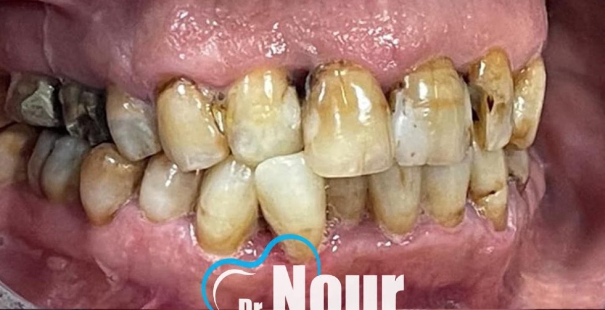 Hollywood Smile procedure before photo at Dr. Nour Clinic – visible dental discoloration