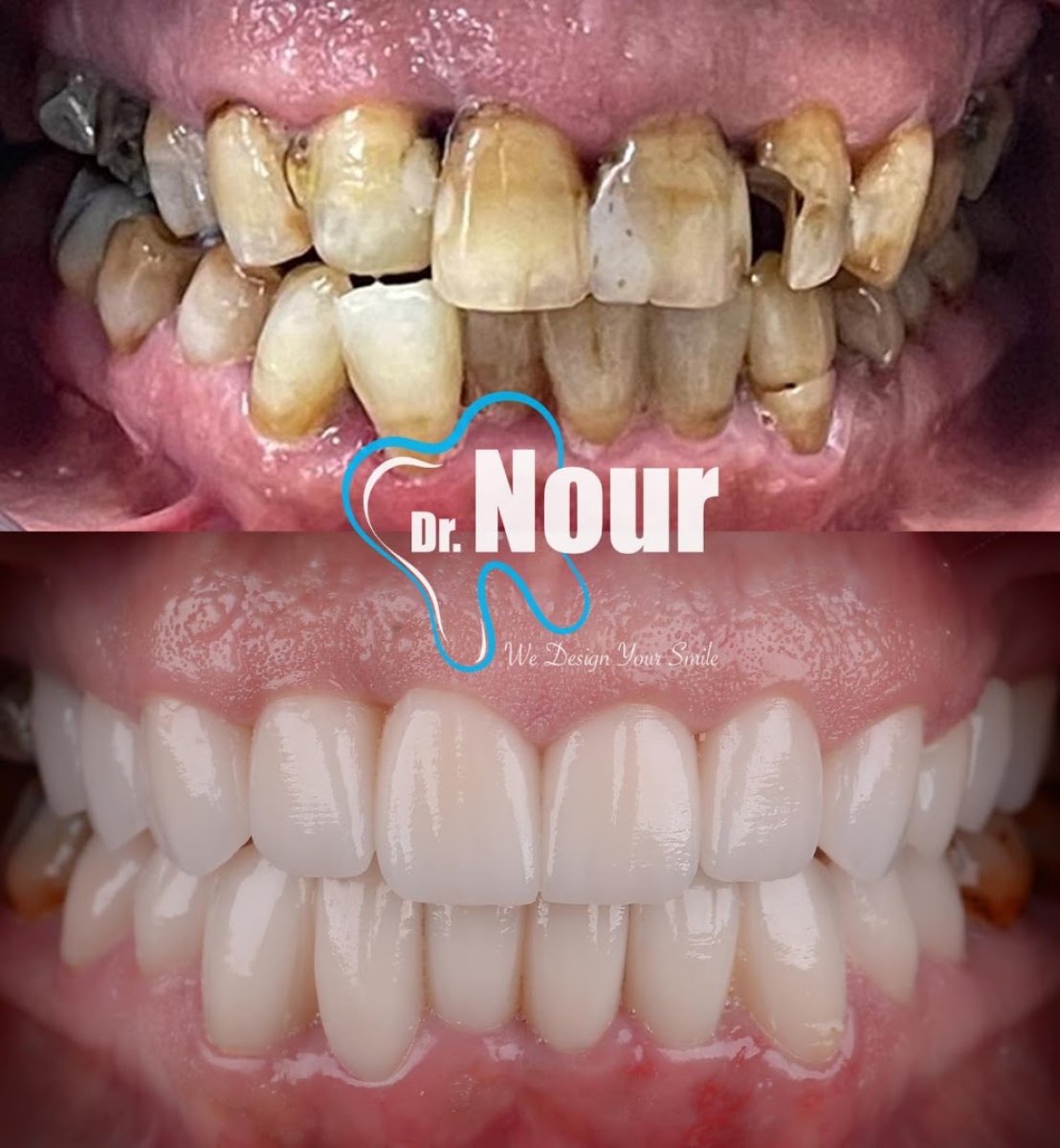 Результаты до и после Hollywood Smile в клинике Dr. Nour – полное восстановление зубов