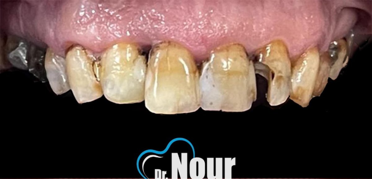 Photo avant Hollywood Smile à la clinique Dr. Nour – décoloration dentaire visible