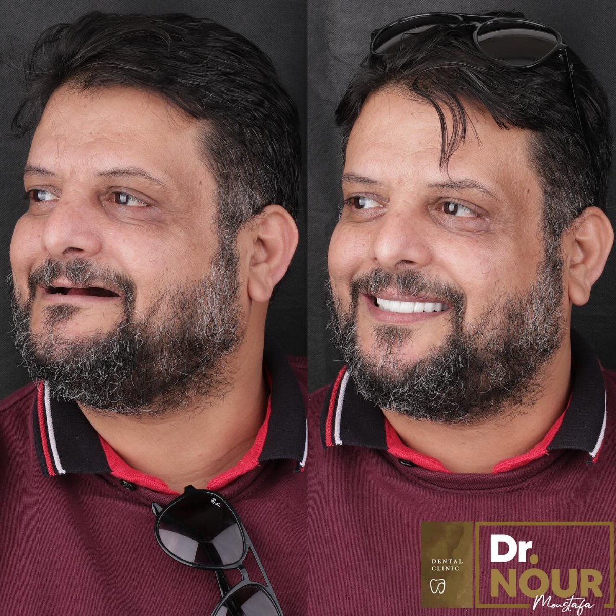 Résultats avant et après implant dentaire à la clinique Dr. Nour Mostafa, sourire restauré