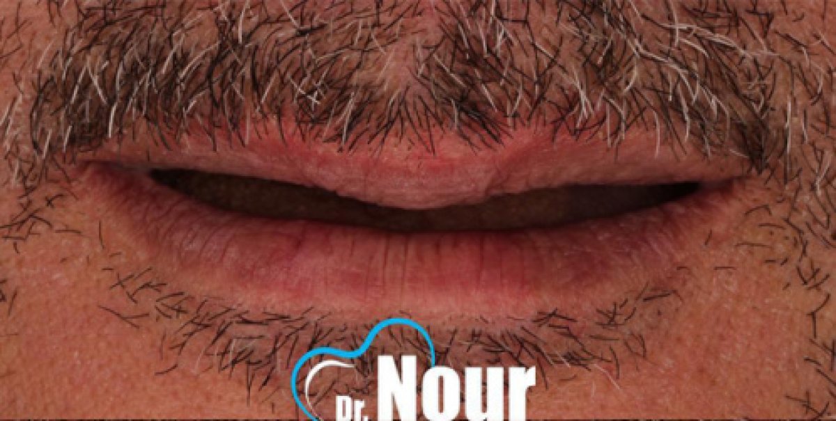 Before full dentures installation at Dr. Nour clinic – missing teeth visible in upper jaw