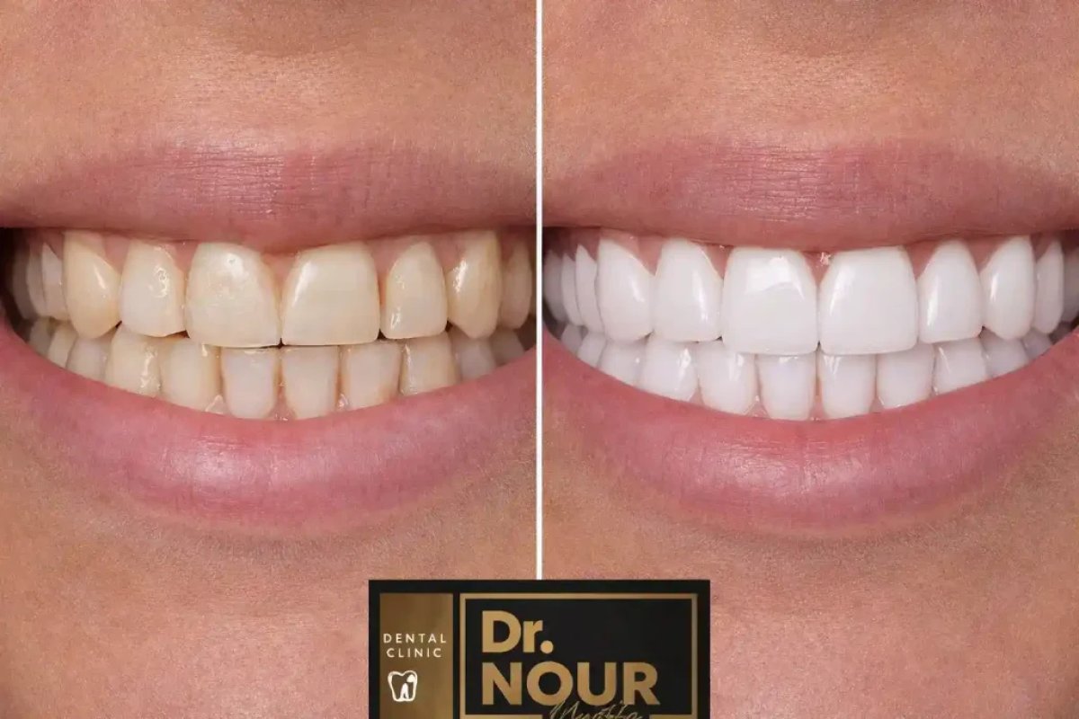 Результати відбілювання зубів до і після в Dr. Nour Dental Clinic – яскравіша посмішка
