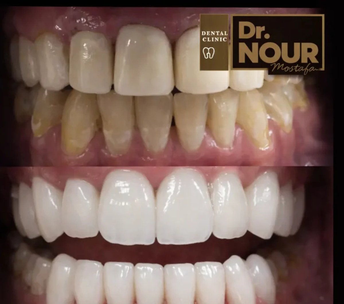 Before and after tooth whitening results at Dr. Nour Dental Clinic – brighter smile transformation