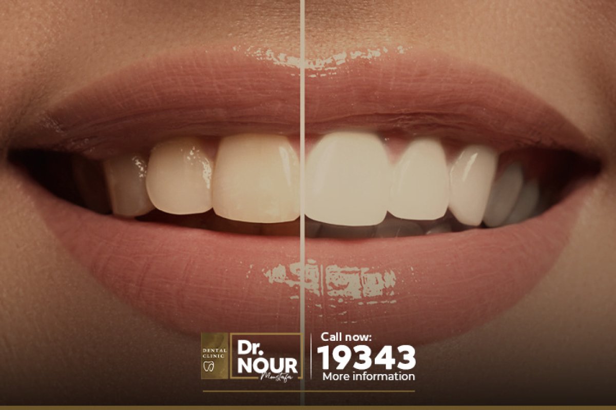 نتائج تبييض الأسنان قبل وبعد في عيادة Dr. Nour Dental Clinic – ابتسامة أكثر إشراقًا