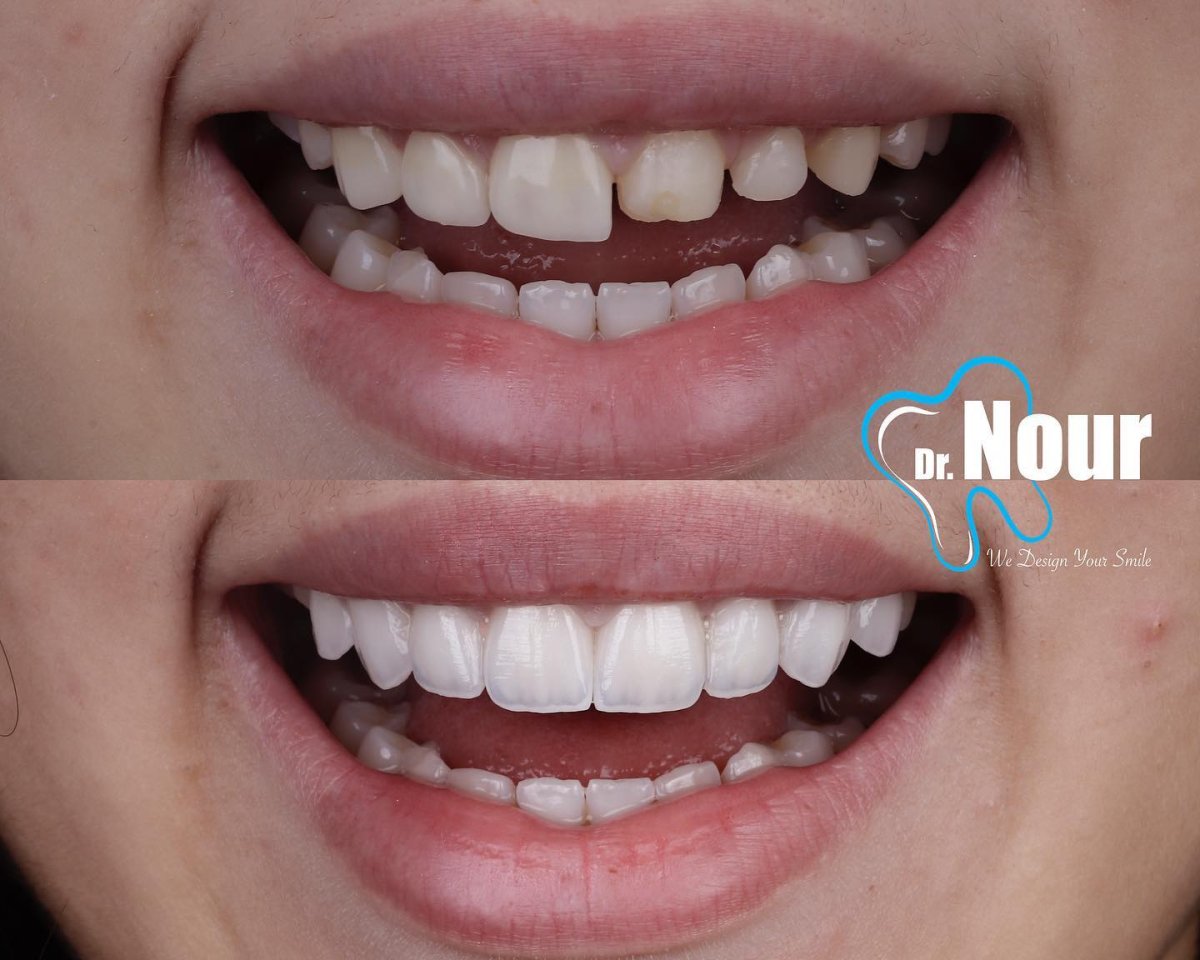 Smile makeover before and after results at Dr. Nour clinic – dental veneers transformation