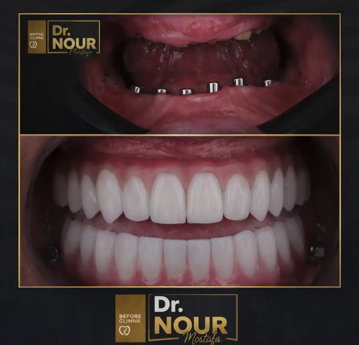 Resultado antes y después de prótesis fija de zirconia sobre 6 implantes en Dr. Nour