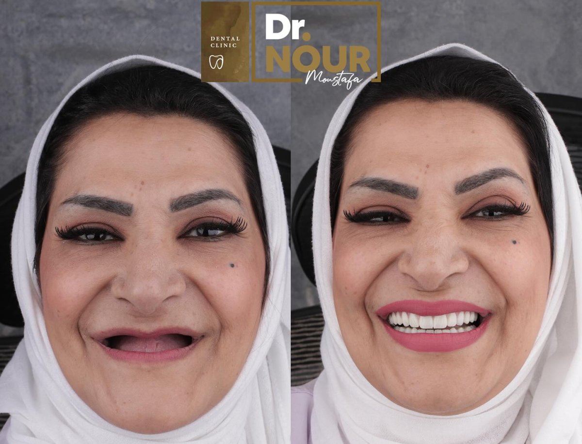 Before and after full-arch implant-fixed zirconia dentures result at Dr. Nour Dental Clinic