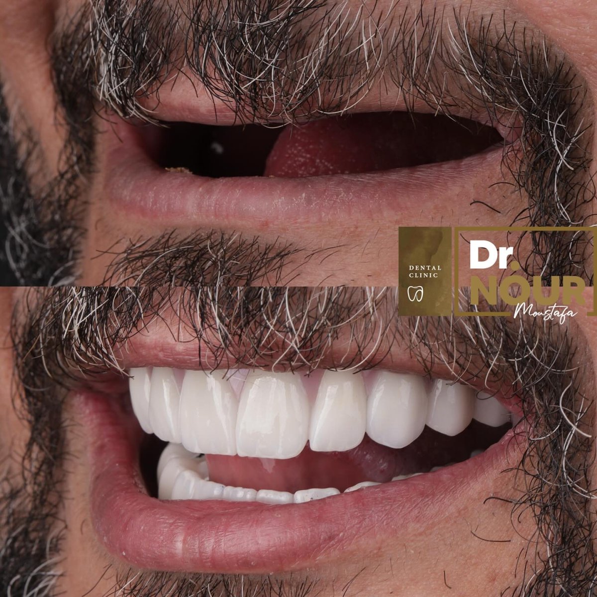 Resultado antes y después de prótesis fija de zirconia sobre 6 implantes en la clínica