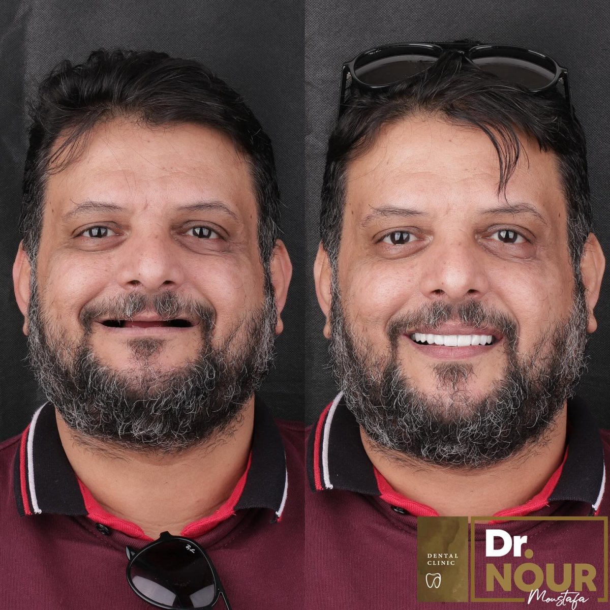 نتيجة قبل وبعد أطقم الأسنان الثابتة بالزركونيا على 6 غرسات في عيادة Dr. Nour