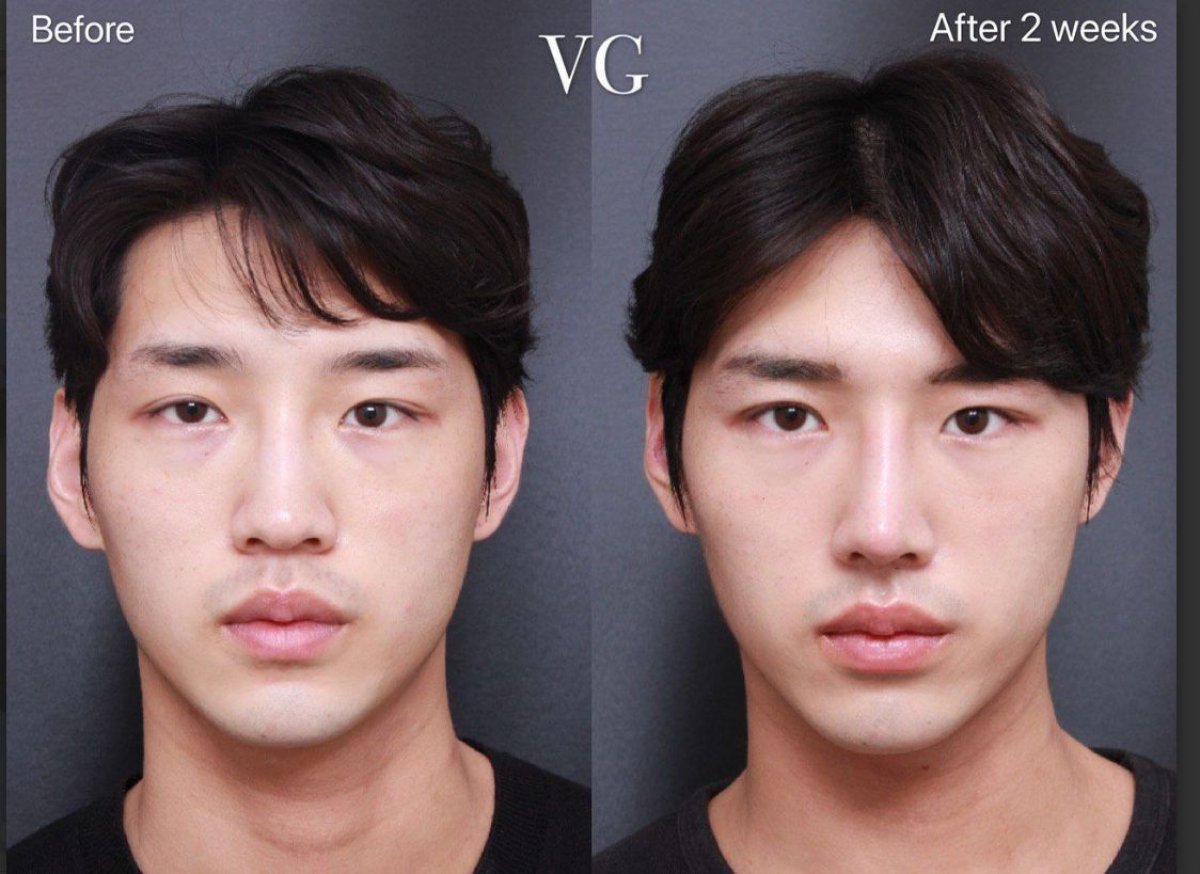Resultados de blefaroplastia antes y después en VG Plastic Surgery – corrección de párpados tras 2 semanas