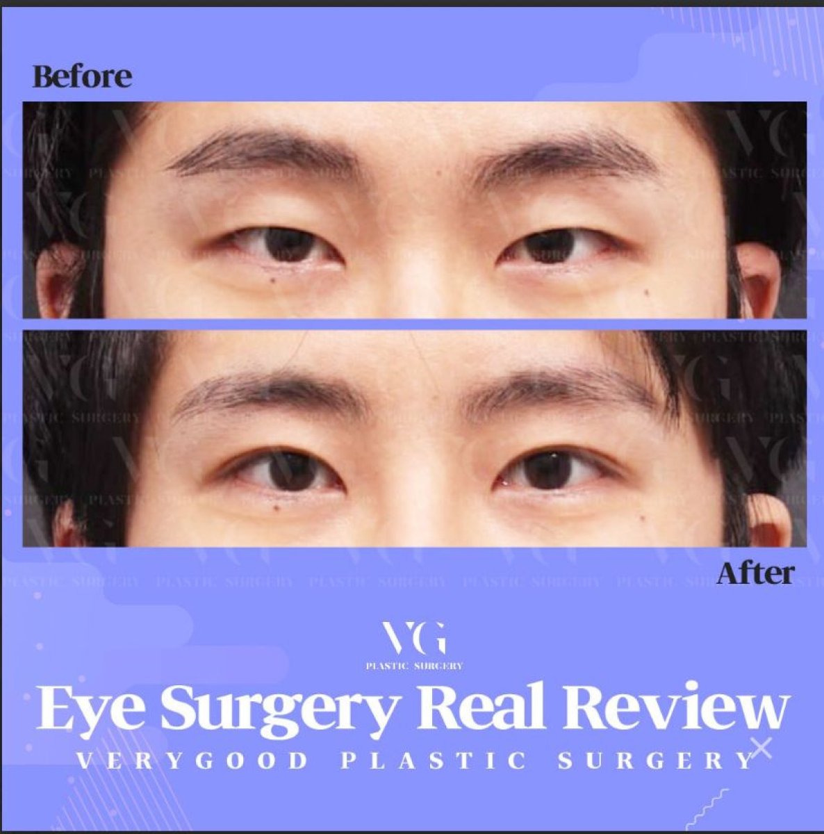 Blepharoplasty before and after results at VG Plastic Surgery – eyelid correction improvement