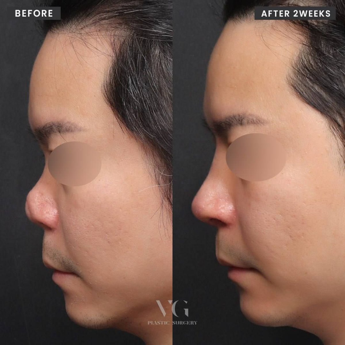 Vorher-nachher-Ergebnisse der Revision-Rhinoplastik bei VG Plastic Surgery, verbesserte Nasenform