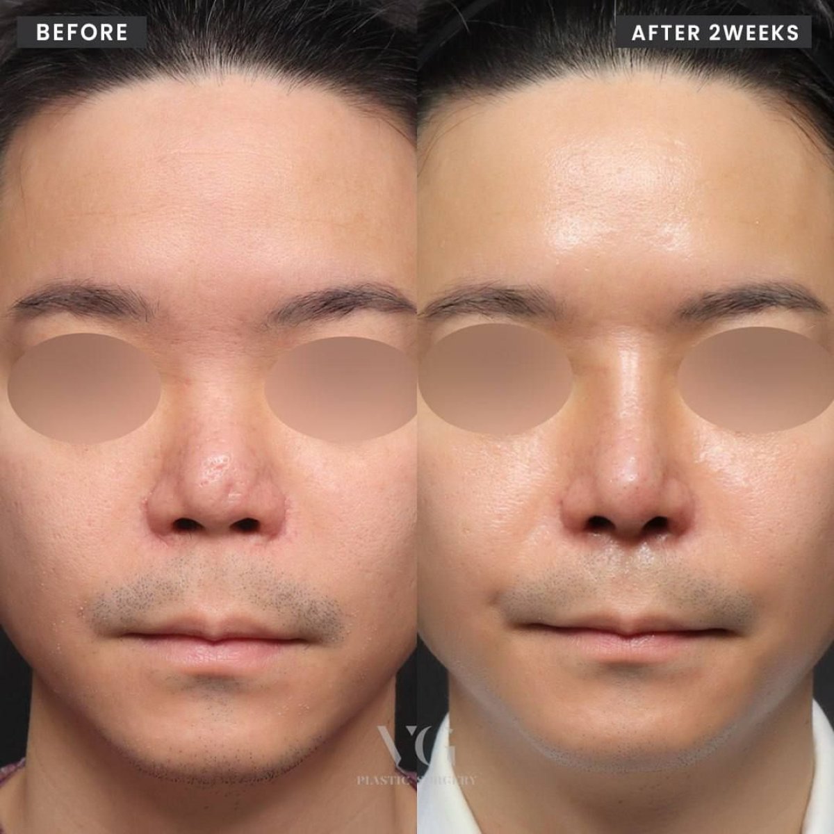 Before and after revision rhinoplasty results at VG Plastic Surgery, improved nose shape