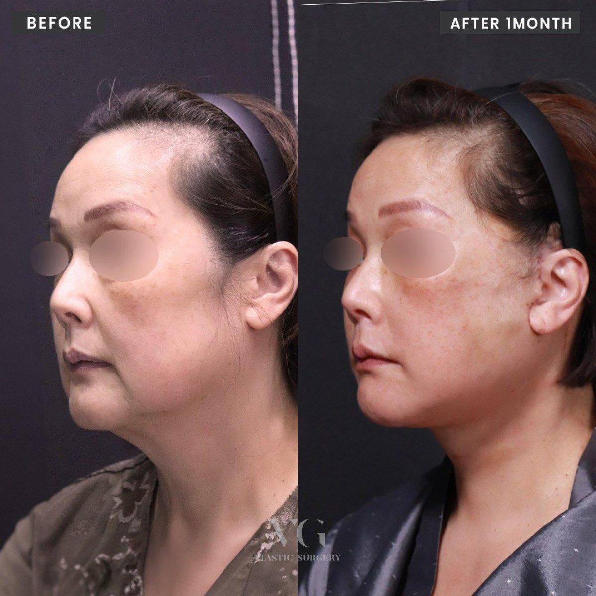 Результаты феминизации лица до и после в VG Plastic Surgery, улучшенный контур челюсти