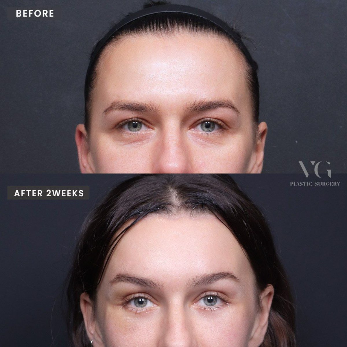 Результати фемінізуючої пластики обличчя до і після у VG Plastic Surgery, 2 тижні після