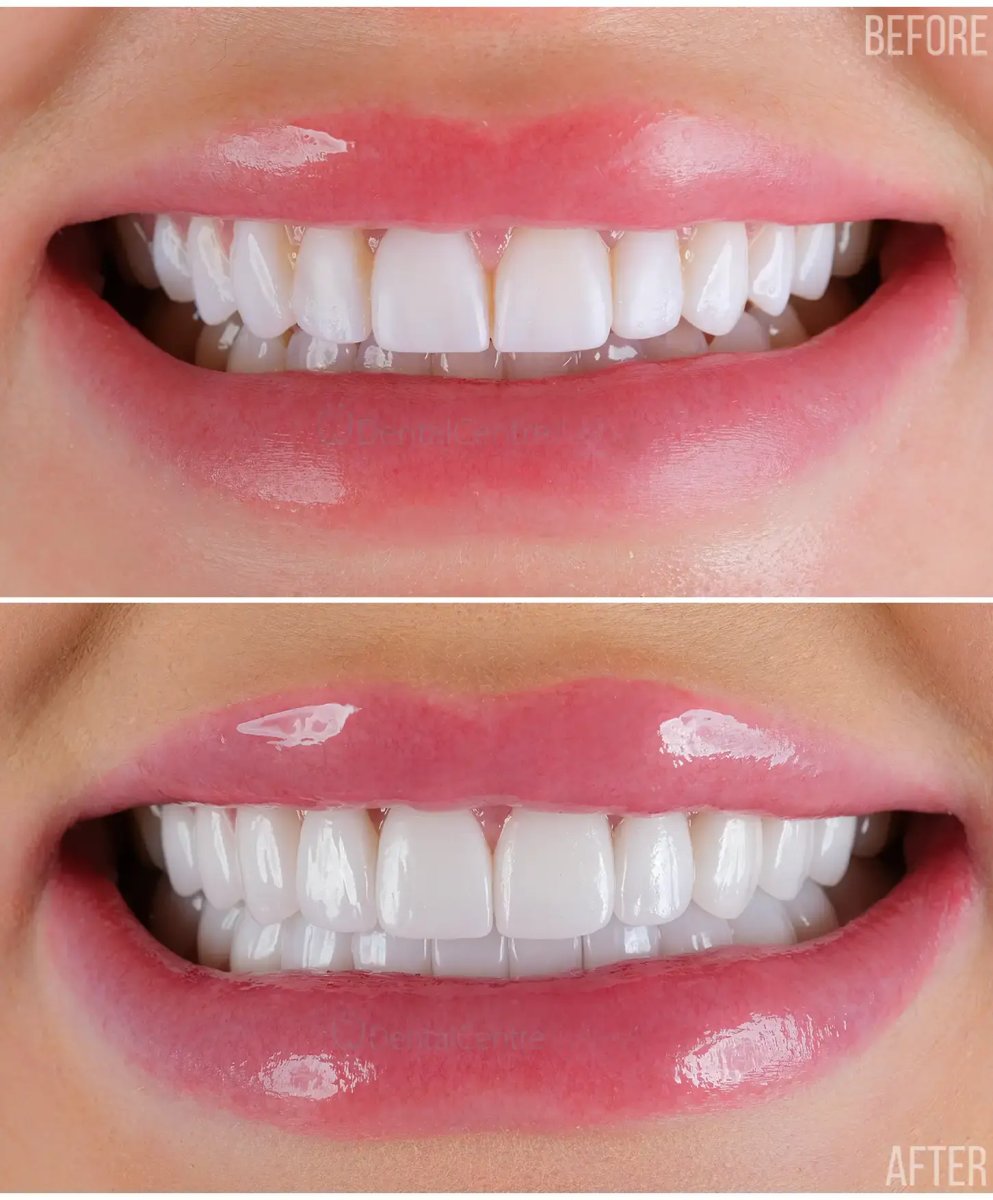 Before and after veneers result – smile makeover with whiter, even teeth at dental clinic
