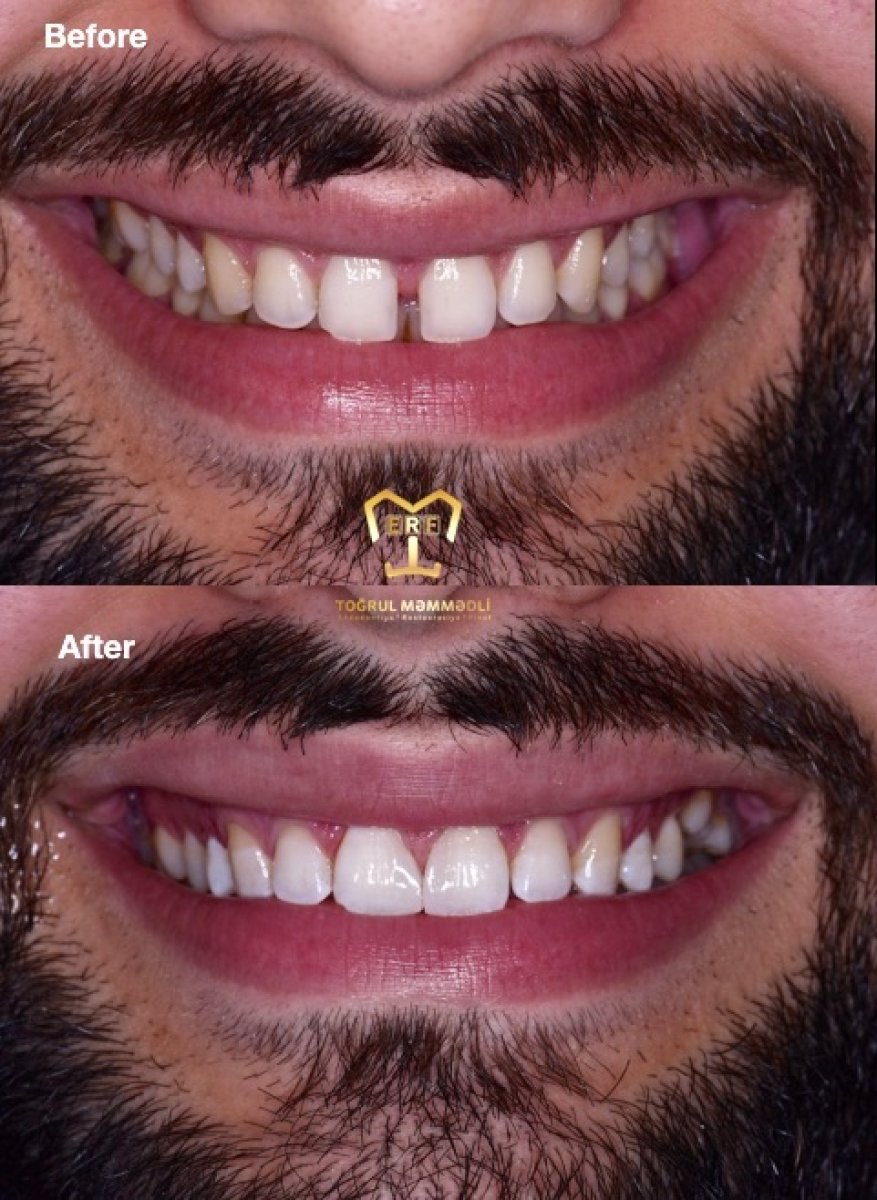Vorher-nachher-Ergebnis Zahnimplantat bei Dentaland Premium Luxury Clinic & Academy, Lächeln erneuert