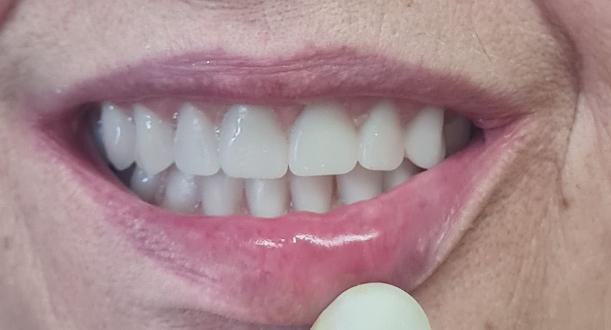 Dental implant result at SoftDentalCare Clinic – restored natural-looking smile after procedure