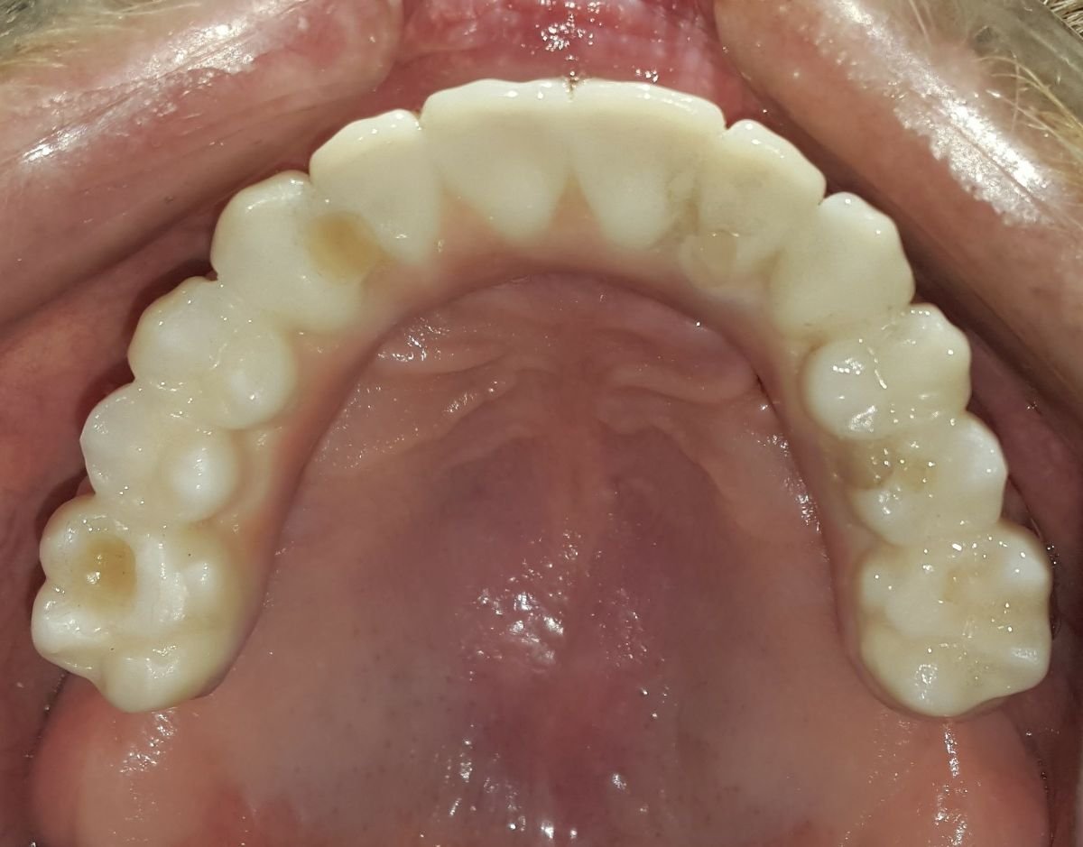 نتيجة زراعة الأسنان All-on-6 في SoftDentalCare Clinic، ترميم قوس الأسنان العلوي