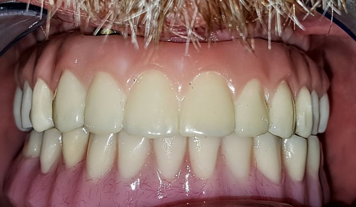 نتيجة زراعة الأسنان All-on-6 في SoftDentalCare Clinic، ابتسامة كاملة مستعادة