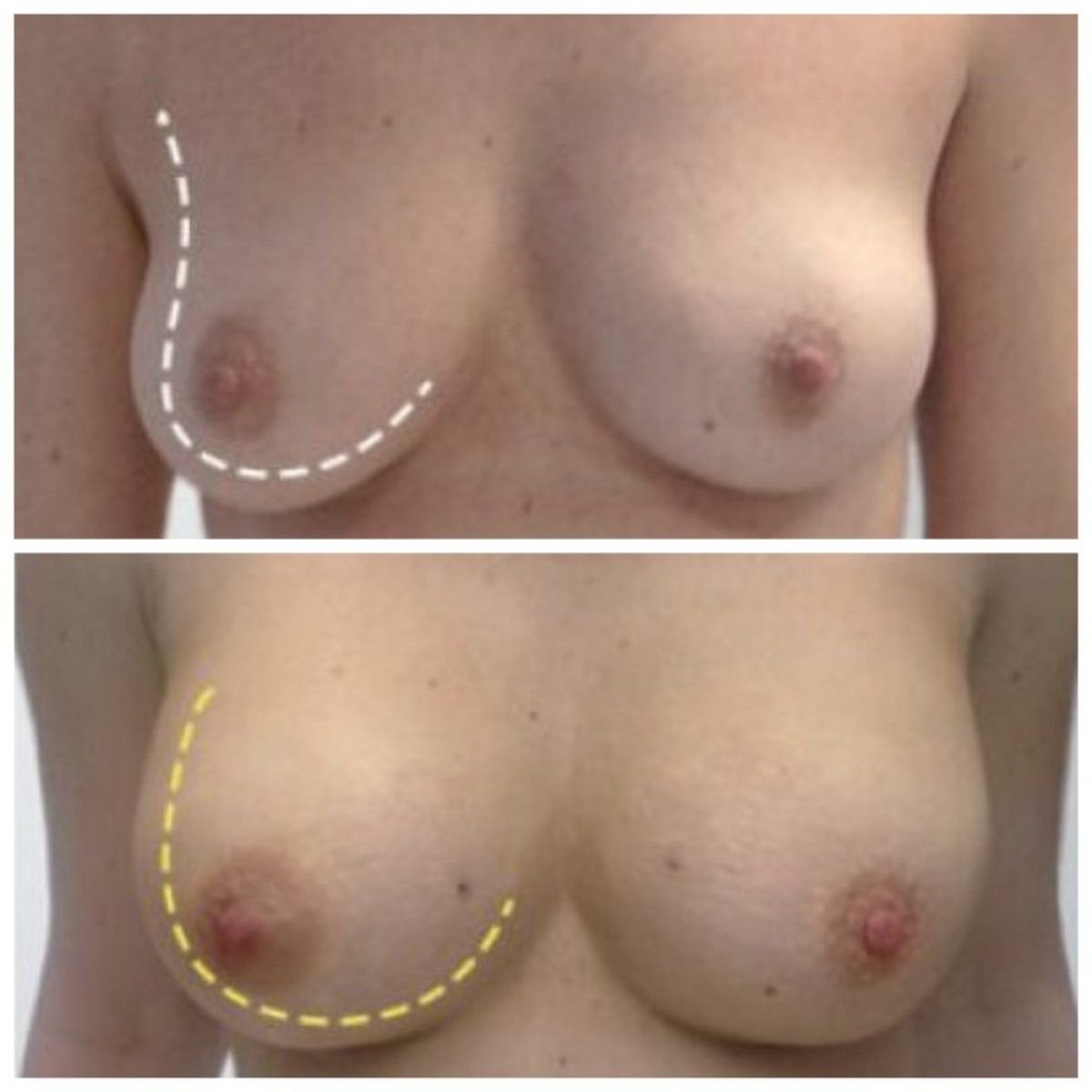 Before and after breast implant revision results at Klinika La Perla, improved breast shape