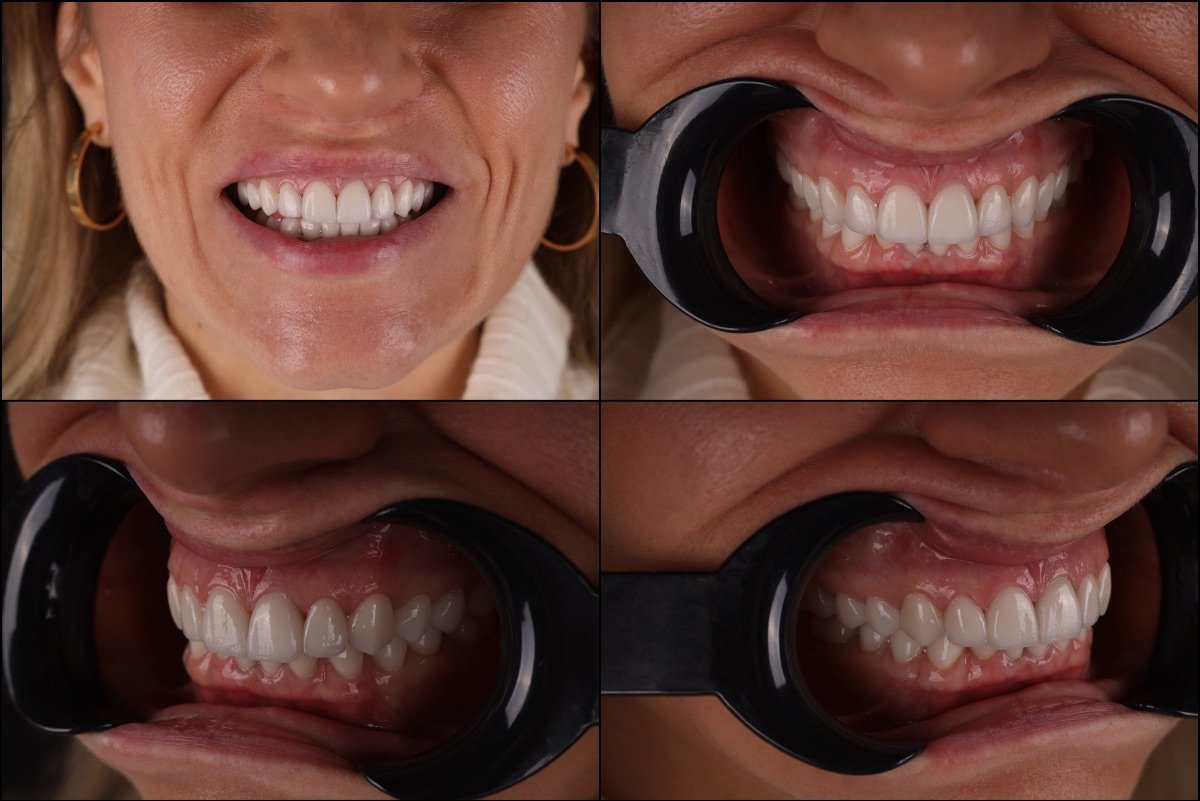 تحول الابتسامة مع قشور الأسنان في عيادة RIKOTA Dental Clinic، نتيجة طبيعية