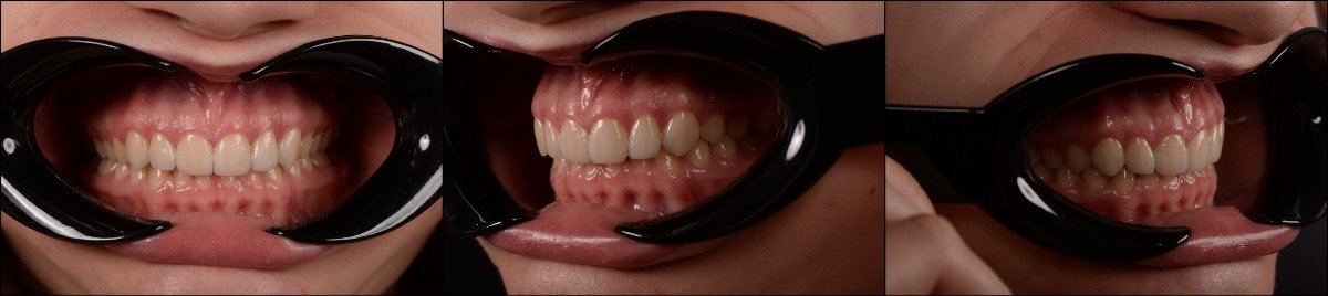 Smile transformation with dental veneers at RIKOTA Dental Clinic – before and after results