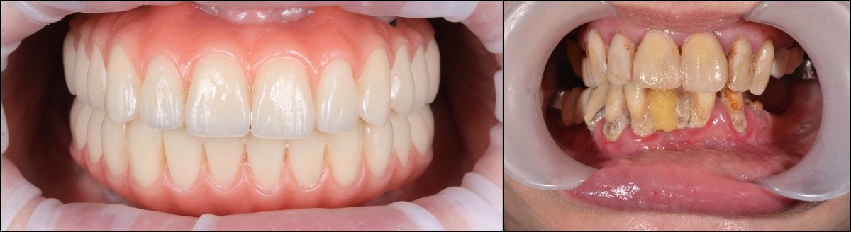 Vorher-nachher-Ergebnis Zahnimplantate bei RIKOTA Dental Clinic – gesundes Lächeln
