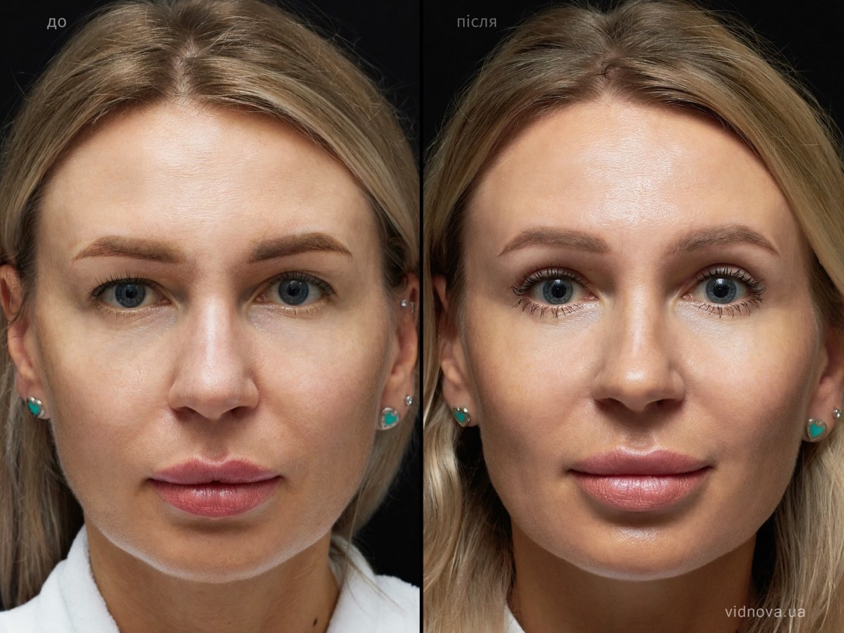 Resultados de blefaroplastia antes y después en Vidnova Clinic – corrección de párpados