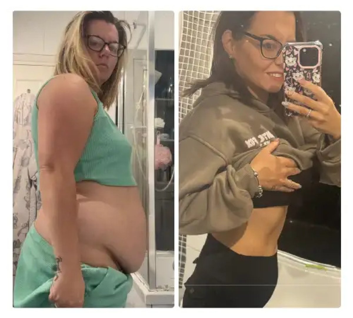 Before and after abdominal liposuction results – visible belly fat reduction and contouring