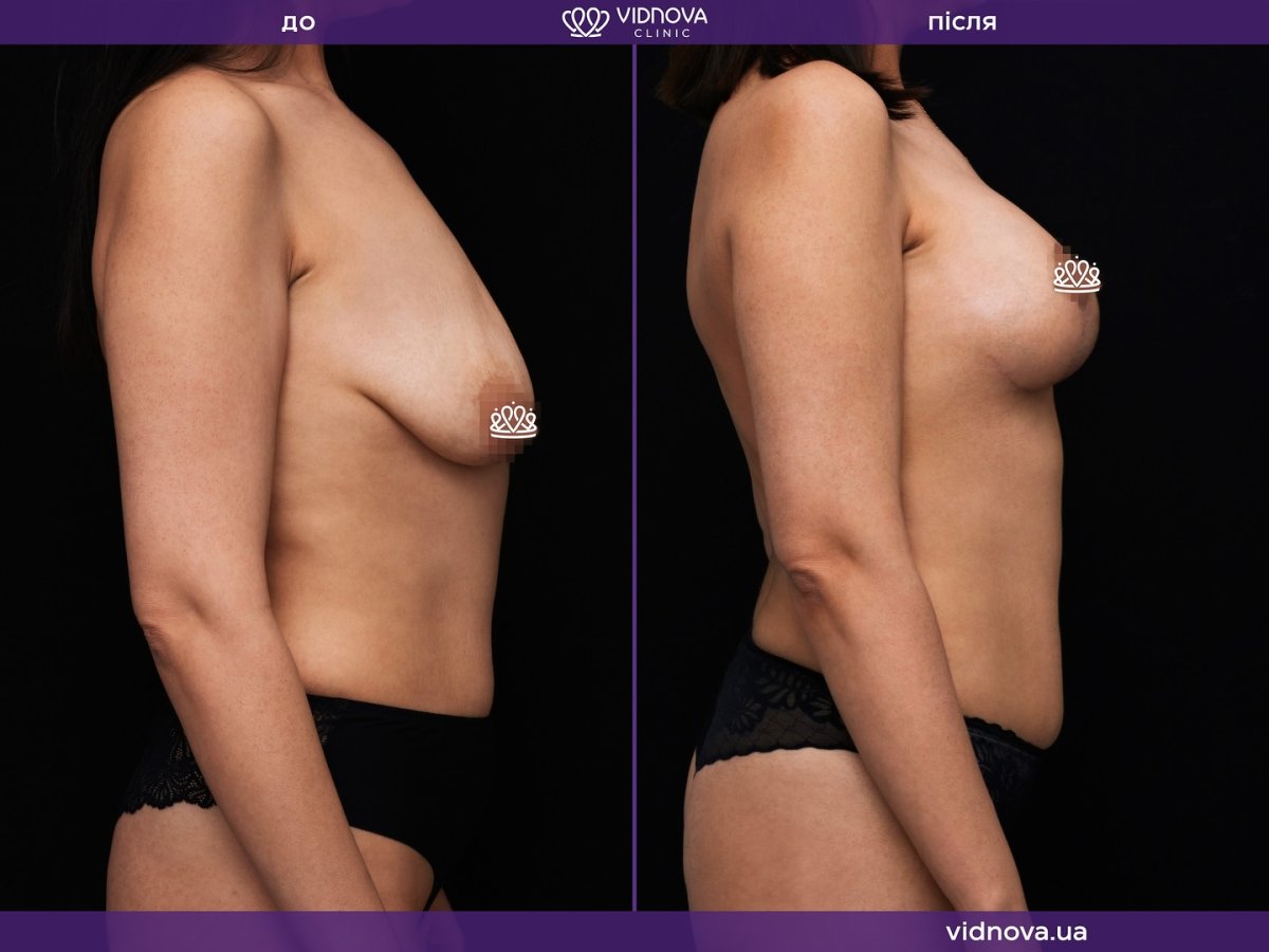 Before and after breast lift results at Vidnova Clinic – improved breast shape and contour