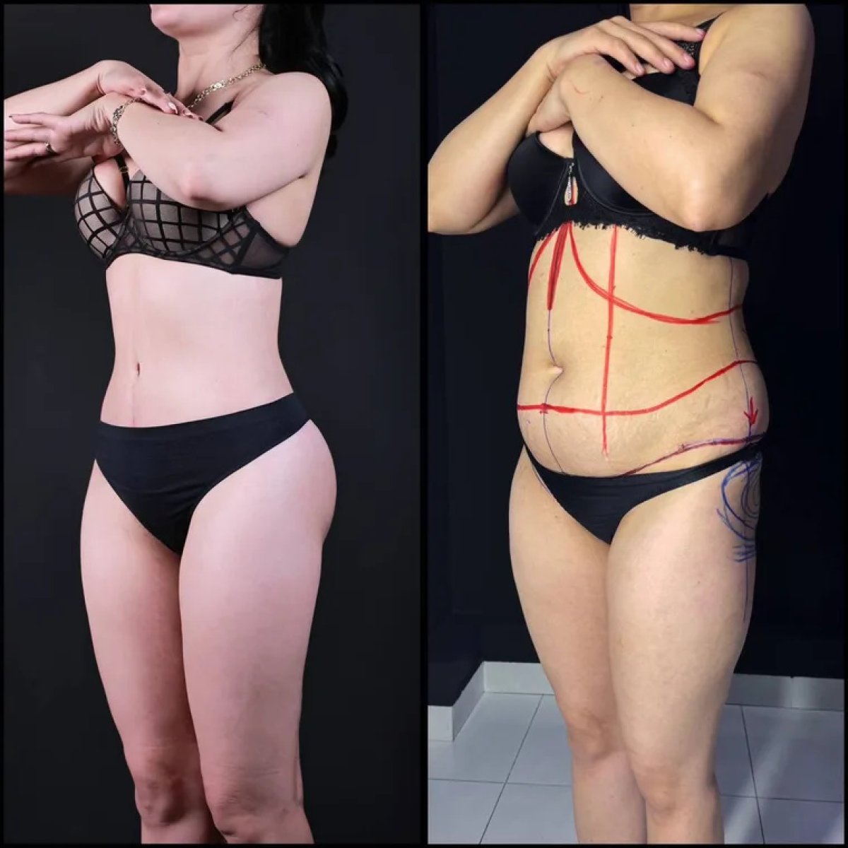 Résultats avant et après abdominoplastie à Renaissance Clinic, amélioration du contour abdominal