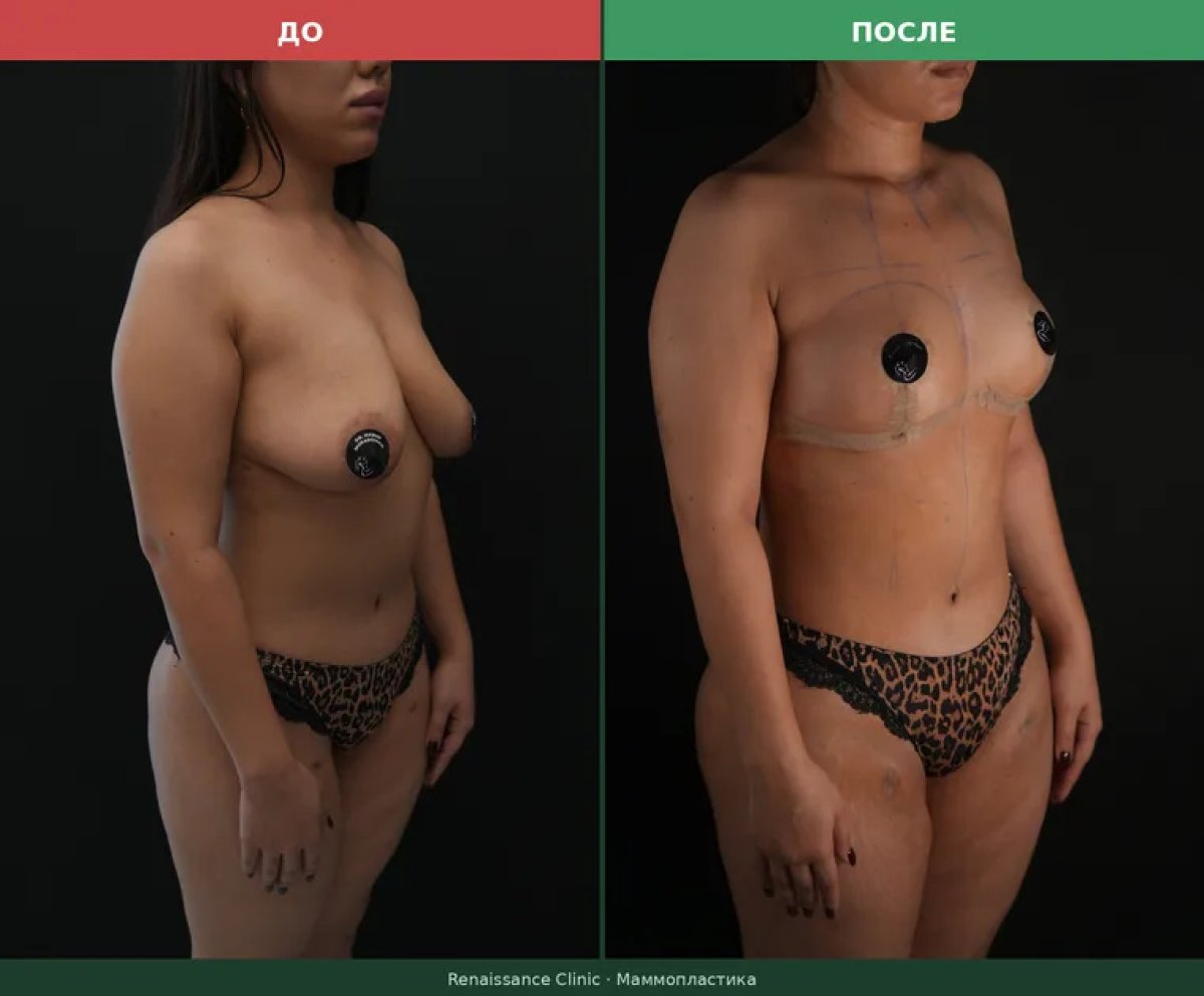 Before and after breast reduction results at Renaissance Clinic, improved breast contour