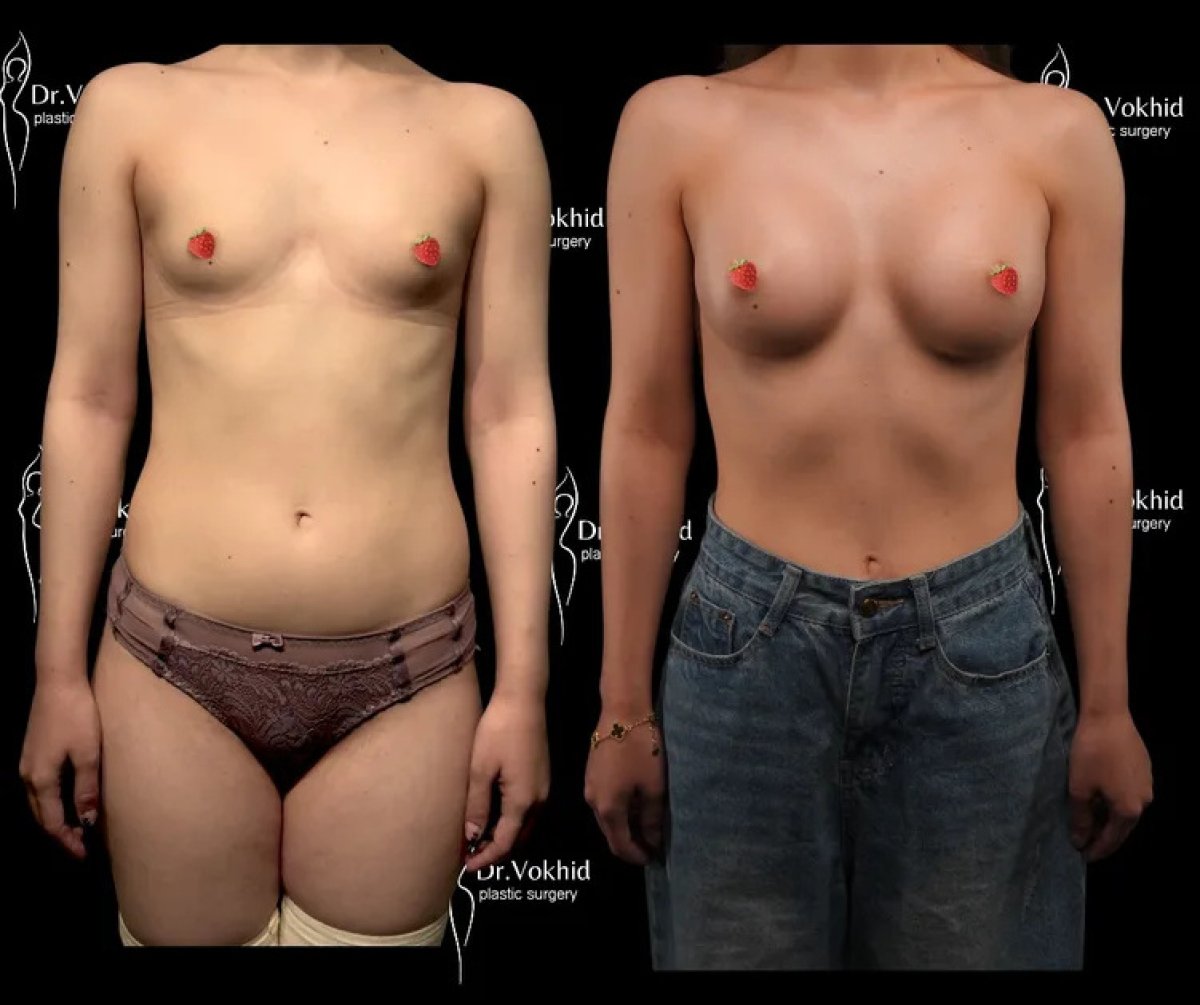 Vorher-nachher-Ergebnis Brustvergrößerung bei Renaissance Clinic, mehr Brustvolumen