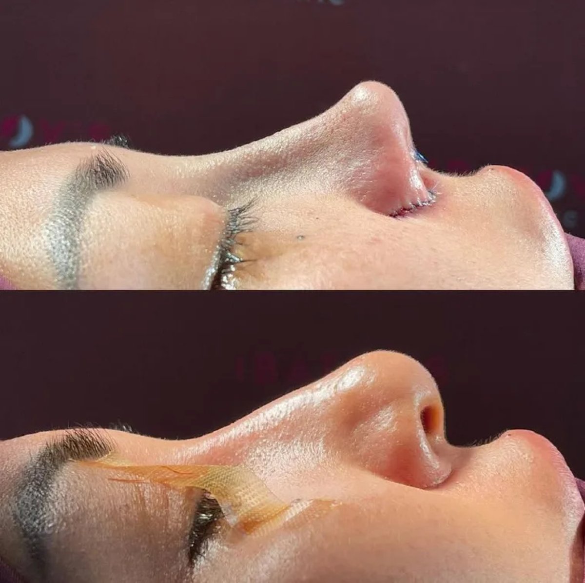 Before and after open rhinoplasty results at Renaissance Clinic, improved nose shape and contour