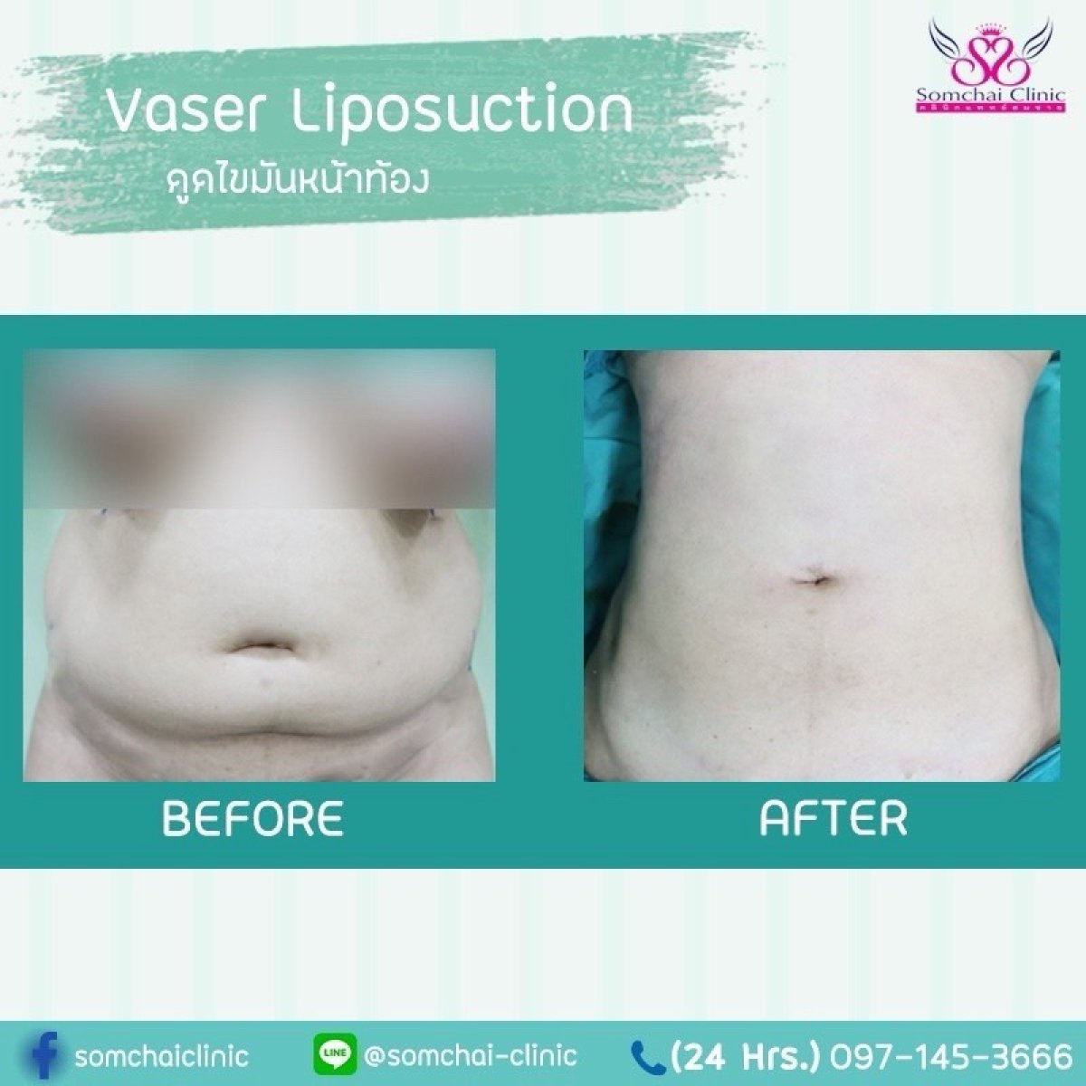 Résultats avant/après liposuccion Vaser abdominale à la clinique Somchai, réduction de graisse